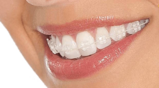 aparelhos-ortodonticos-transparentes