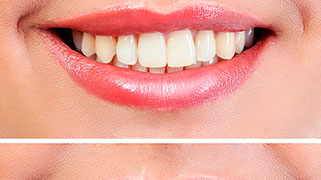 clareamento natural dos dentes