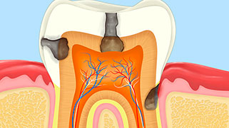 nevralgia-dentaria-sintomas