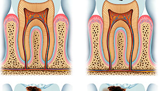 nevralgia-nos-dentes-sintomas