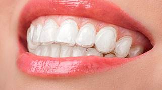 Valor de clareamento dental