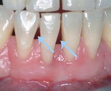 cirurgia na gengiva retraída