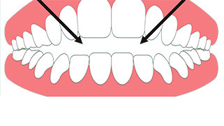 cirurgia mordida aberta