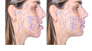 cirurgia ortognática antes e depois