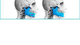 cirurgia ortognática estética