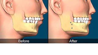 cirurgia ortognática pós operatório