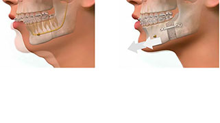 cirurgia ortognática