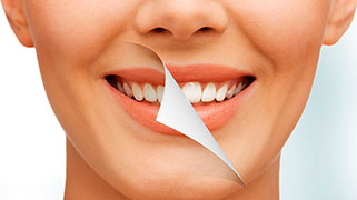 clareamento dental a laser valor