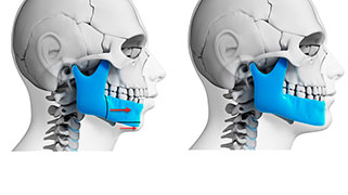 disostose bucomaxilofacial