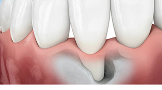 enxerto ósseo dentário preço