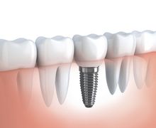 implantes dentarios preço