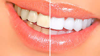 Limpeza e clareamento dental preço