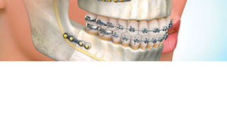 Preço cirurgia ortognática