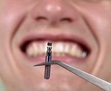 quanto custa um implante dentário
