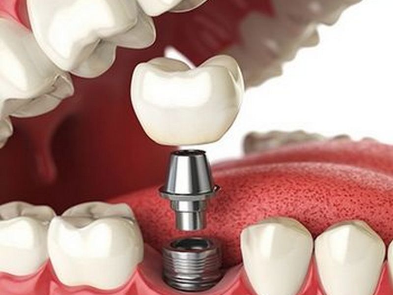 implante de dente
