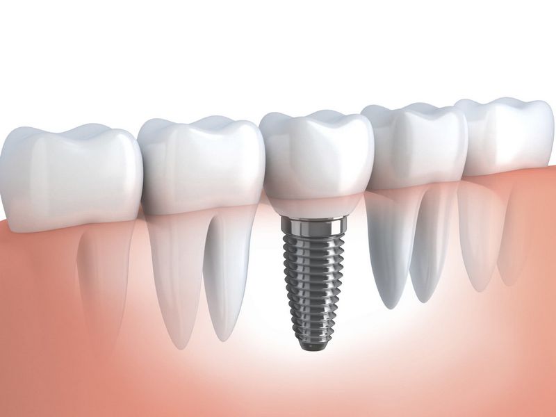 implantes dentarios preço