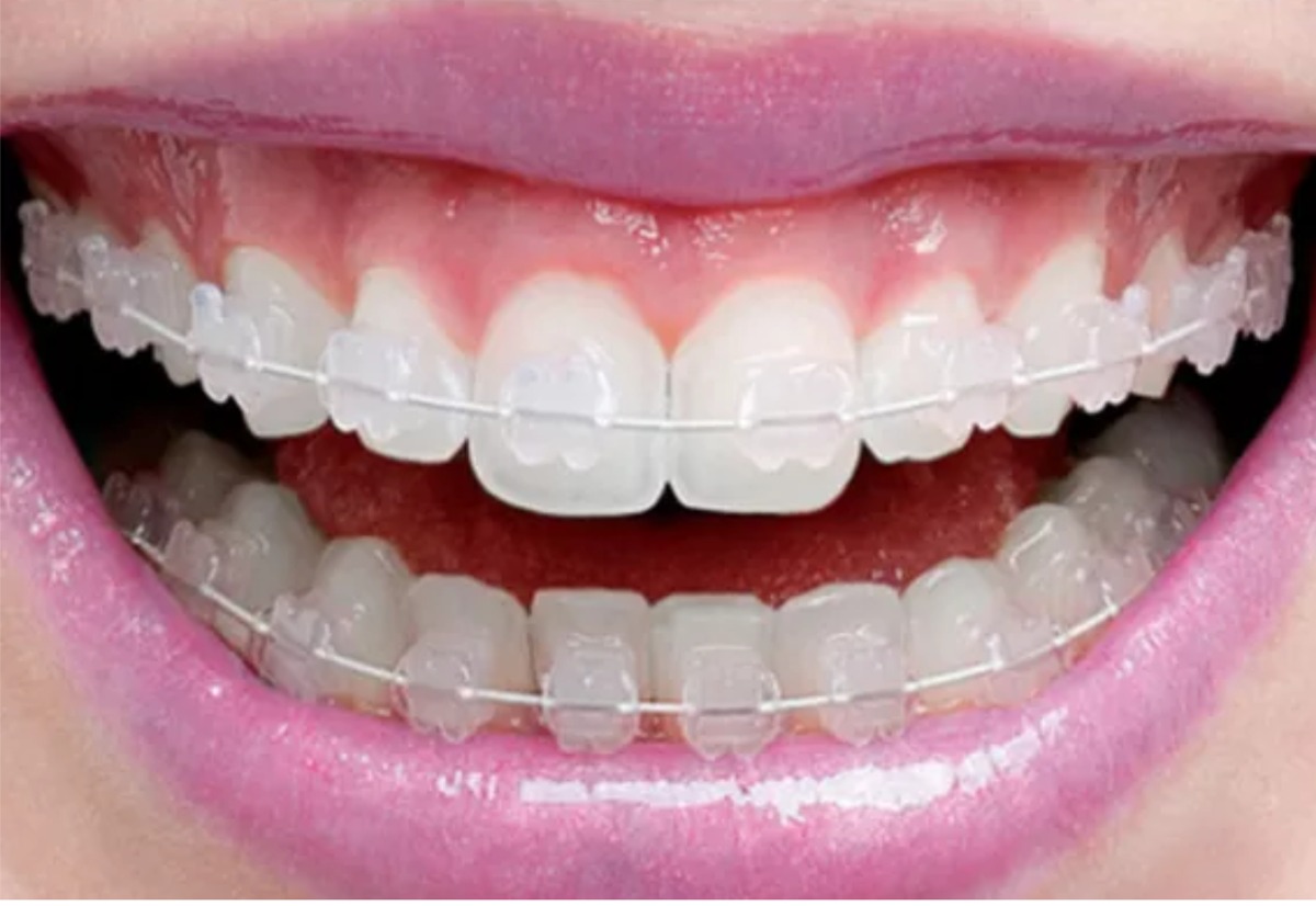 aparelho-dentario-estetico