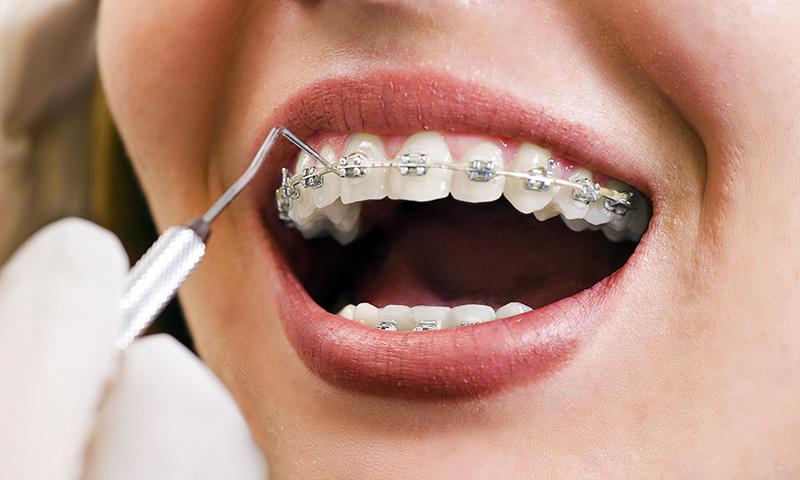 aparelho-ortodontico