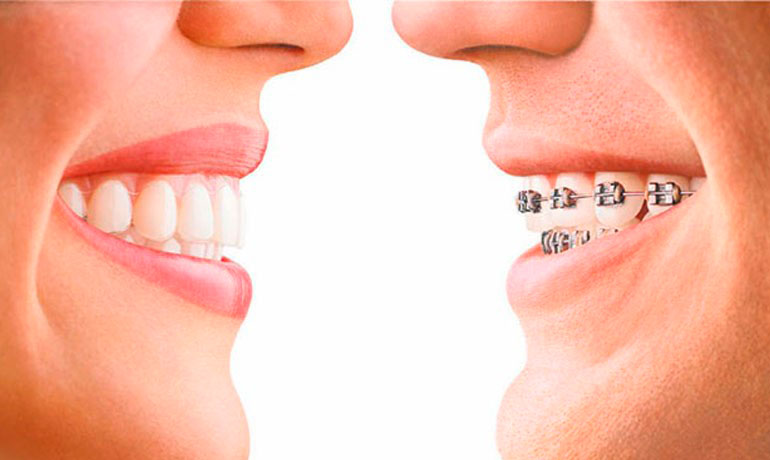 aparelho-ortodontico-estetico