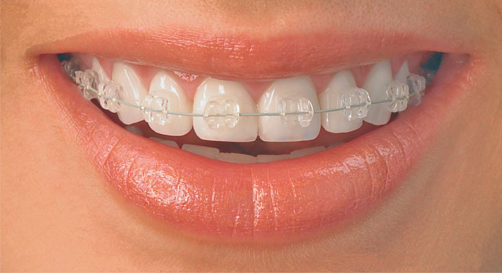 aparelho-ortodontico-estetico-preco