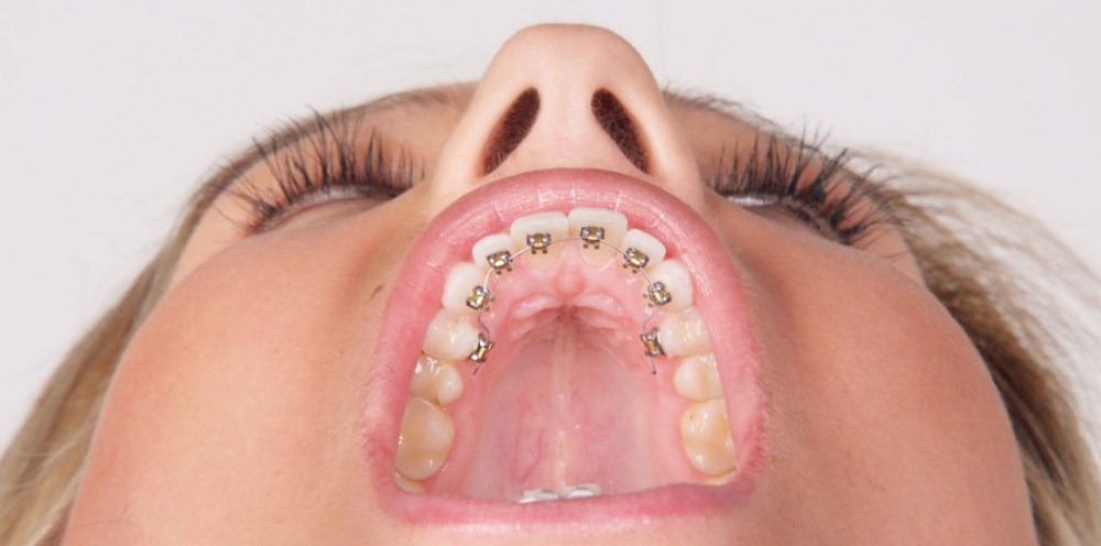 aparelho-ortodontico-lingual
