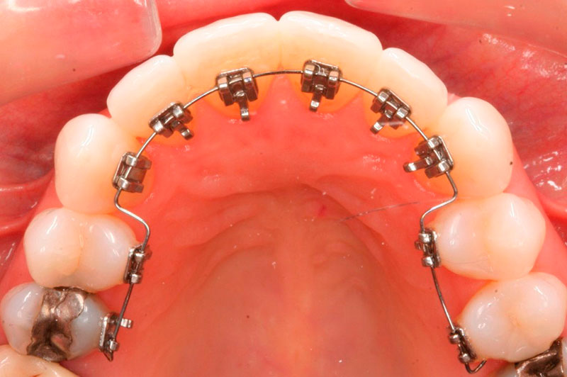 aparelho-ortodontico-lingual-preco