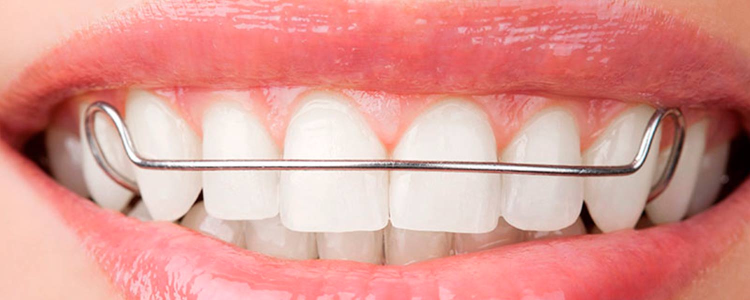aparelho-ortodontico-movel