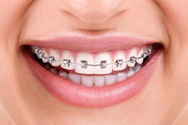 aparelho-ortodontico-preco