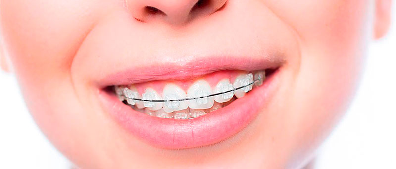 aparelho-ortodontico-transparente-preco