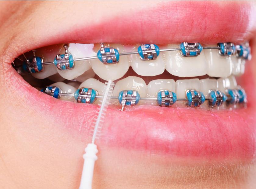 aparelhos-dentarios