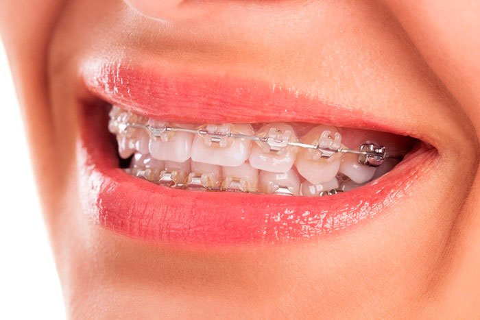 aparelhos-ortodonticos-precos