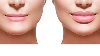 Botox lábios antes e depois