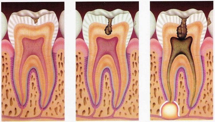canal-dentario