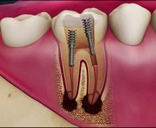 canal de dente