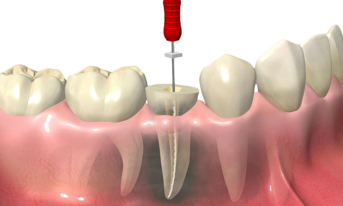 canal-odontologico