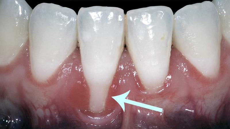 cirurgia-enxerto-gengiva