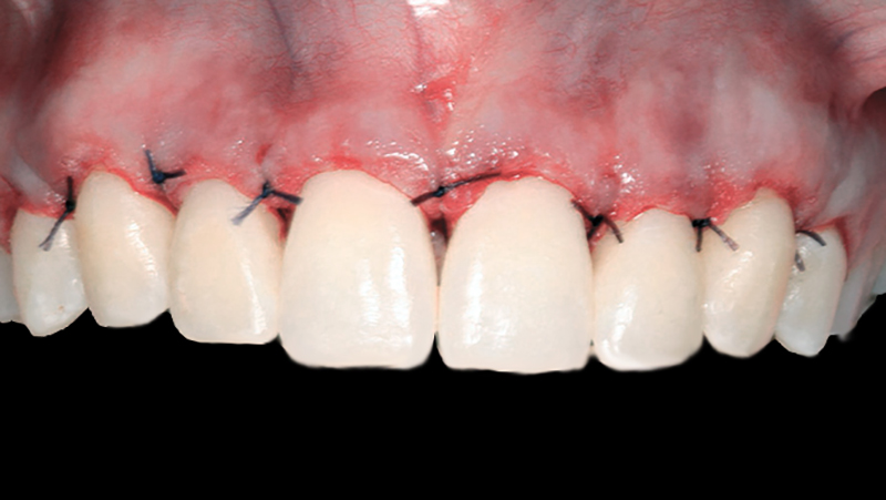 cirurgia-enxerto-gengival