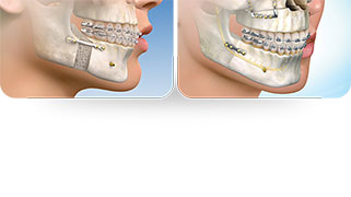 Cirurgia maxilar recuperação