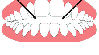 cirurgia mordida aberta