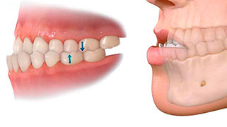 cirurgia mordida cruzada antes e depois