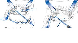 cirurgia odontologia maxilar