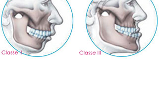 cirurgia-ortognatica-beneficio-antecipado