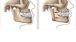 Cirurgia ortognática classe 2 antes e depois