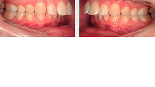 cirurgia ortognática classe 2