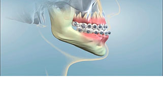 cirurgia-ortognatica-classe-3