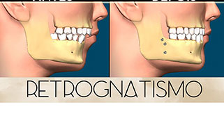 cirurgia-ortognatica-face-curta