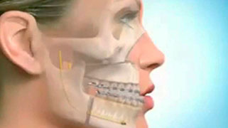 cirurgia-ortognatica-mandibula