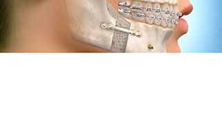 cirurgia-ortognatica-maxilar-superior