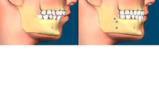 cirurgia-ortognatica-preco