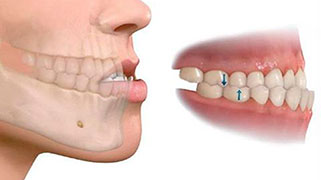 cirurgia ortognática prognatismo